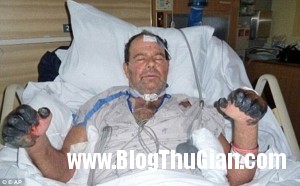 Mất hết tứ chi sau vết cắn của mèo m1 300x186 Mất hết tứ chi sau vết cắn của mèo