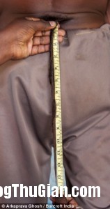 Người đàn ông mọc đuôi dài 36cm nguoi dan ong moc duoi dai 36cm5 158x300 Người đàn ông mọc đuôi dài 36cm