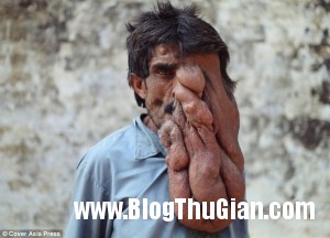 140321 1mat faf50 300x216 Chung sống với khối u nặng 4kg trên khuôn mặt