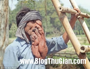 140321 2mat faf50 300x228 Chung sống với khối u nặng 4kg trên khuôn mặt