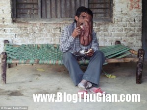 140321 4mat faf50 300x225 Chung sống với khối u nặng 4kg trên khuôn mặt