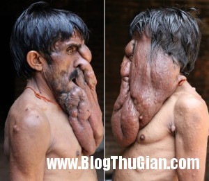 140321 7mat faf50 300x261 Chung sống với khối u nặng 4kg trên khuôn mặt