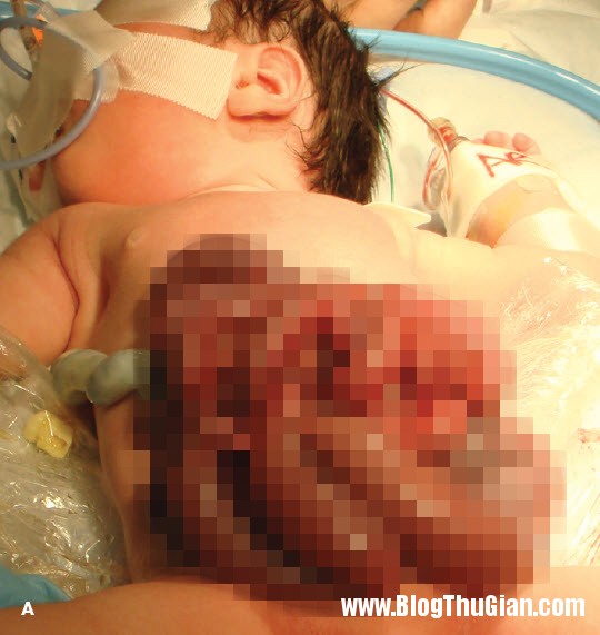 be so sinh chao doi voi ruot loi ra khoi o bung jpg0  Bé sơ sinh chào đời với nội tạng nằm ngoài ổ bụng 