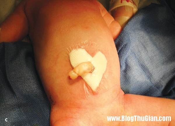 be so sinh chao doi voi ruot loi ra khoi o bung jpg11  Bé sơ sinh chào đời với nội tạng nằm ngoài ổ bụng 