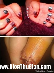 s2 aadd5 223x300 Cô gái phải cưa bỏ ngón tay vì nước sơn móng