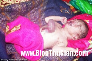 140401 5tim 0e20f 300x199 Bé trai chào đời với trái tim nằm ngoài lồng ngực