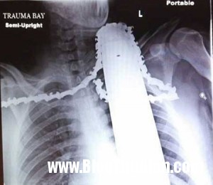 140402 1cua 47201 300x260 Người đàn ông thoát chết kỳ diệu khi bị lưỡi cưa găm chặt vào cổ.