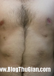 140417 1num 36dd4 214x300 Người đàn ông có tới 6 núm vú