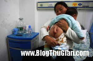 ad 133124463 1553 1398480243 300x199 Đứa trẻ 5 tháng tuổi và chiếc đuôi dài 13 cm.