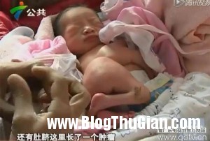 b1 90bbb 300x202 Bé sơ sinh chào đời với chân dính vào bụng