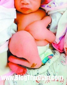 b2 90bbb 237x300 Bé sơ sinh chào đời với chân dính vào bụng