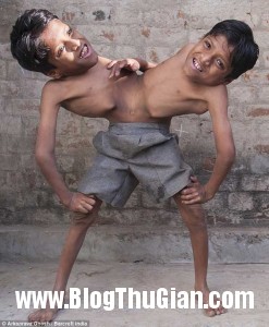 song sinh 1 247x300 Cuộc sống đầy nghị lực của hai cậu bé có thân hình dín nhau