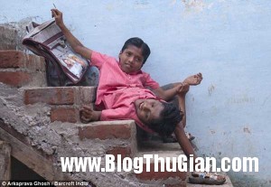 song sinh 2ok 300x207 Cuộc sống đầy nghị lực của hai cậu bé có thân hình dín nhau