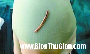 20140422164445 6799 1398423210 300x180 Mắc xương cá, bị chuẩn đoán ung thư