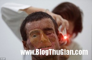 benhla1 20f22 300x196 Căn bệnh lạ khiến cơ thể không tiếp xúc được với ánh nắng mặt trời