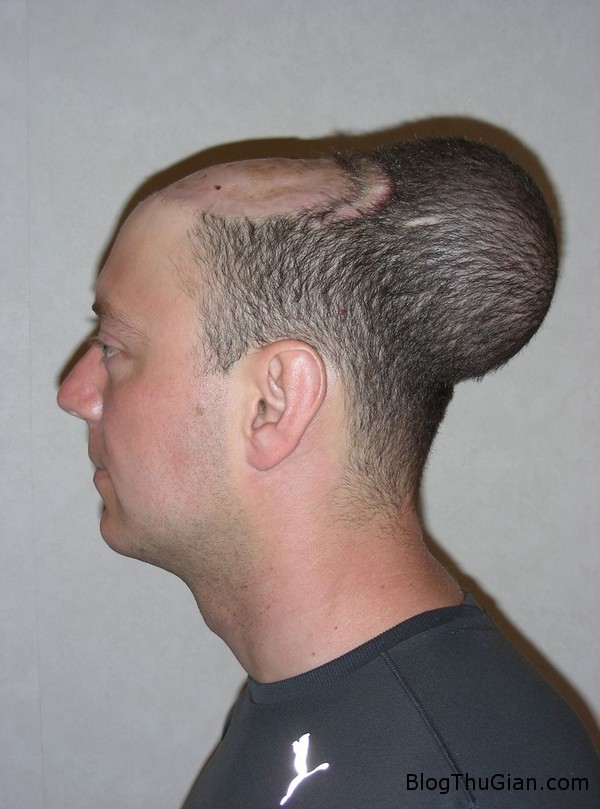 Người đàn ông mang khối u như cái đầu thứ 2 140625 1dau 3228d Người đàn ông mang khối u như cái đầu thứ 2