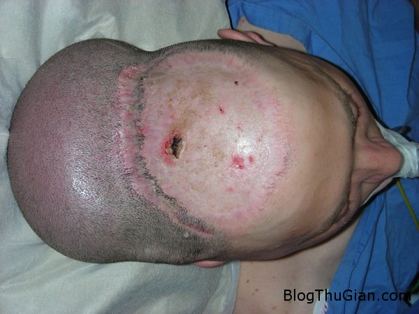 Người đàn ông mang khối u như cái đầu thứ 2 140625 2dau 3228d Người đàn ông mang khối u như cái đầu thứ 2