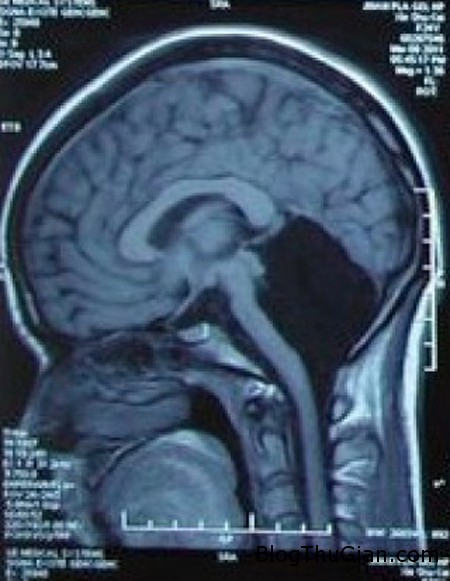 Cô gái đặc biệt bị thiếu hụt tiểu não vẫn sống được trong khoảng thời gian dài 140912 1nao b57e6 Cô gái đặc biệt bị thiếu hụt tiểu não vẫn sống được trong khoảng thời gian dài