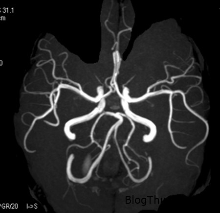 Cô gái đặc biệt bị thiếu hụt tiểu não vẫn sống được trong khoảng thời gian dài 140912 2nao b57e6 Cô gái đặc biệt bị thiếu hụt tiểu não vẫn sống được trong khoảng thời gian dài
