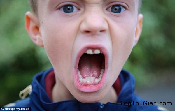 cậu bé đặc biệt có hai hàm răng mọc chồng lên nhau 141002 2rang c722d cậu bé đặc biệt có hai hàm răng mọc chồng lên nhau