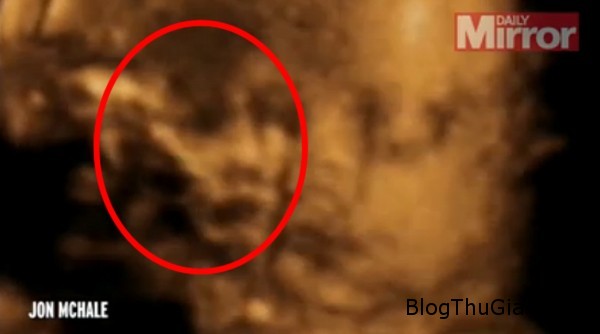 bat ngo voi hinh mat nguoi xuat hien trong video sieu am thai nhi 4 chieu Phát hiện mặt người trong hình ảnh siêu âm