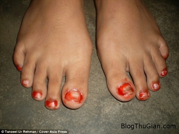 Cô bé 15 tuổi có dịch rỉ ra từ mắt và da có màu đỏ như máu co be 15 tuoi nguoi an do khoc va toat mo hoi mau1 Cô bé 15 tuổi có dịch rỉ ra từ mắt và da có màu đỏ như máu