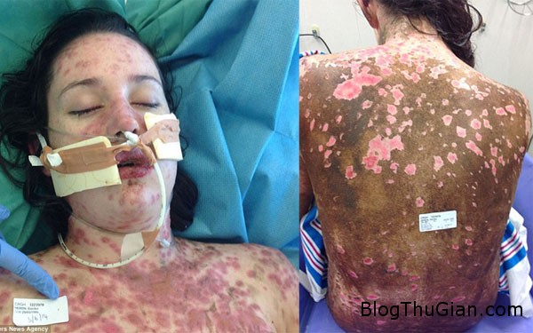 Mắc bệnh lạ da trên cơ thể cô gái xinh đẹp phồng rộp và đỏ tấy như người bị phỏng nặng mac benh la thieu nu bi troc da phong rop nhu bong nang1 Mắc bệnh lạ da trên cơ thể cô gái xinh đẹp phồng rộp và đỏ tấy như người bị phỏng nặng