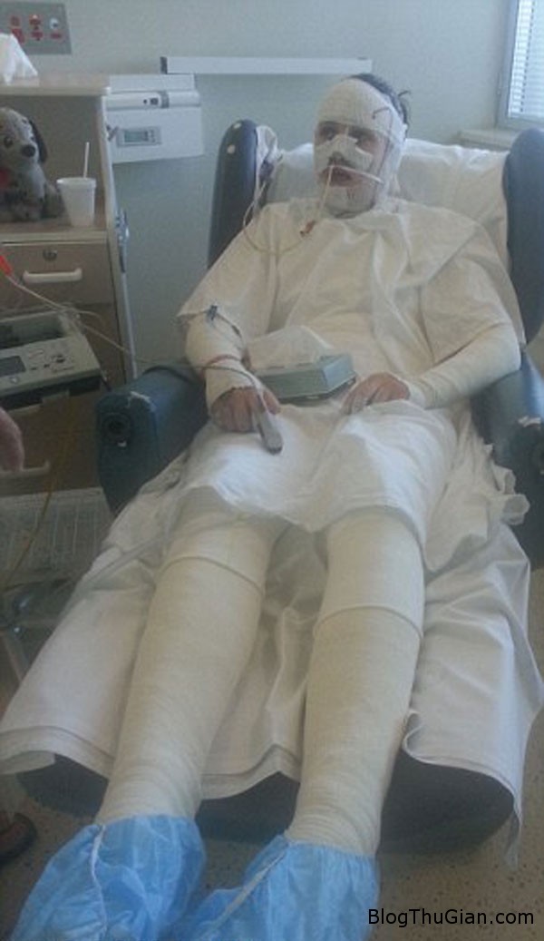 Mắc bệnh lạ da trên cơ thể cô gái xinh đẹp phồng rộp và đỏ tấy như người bị phỏng nặng mac benh la thieu nu bi troc da phong rop nhu bong nang2 Mắc bệnh lạ da trên cơ thể cô gái xinh đẹp phồng rộp và đỏ tấy như người bị phỏng nặng