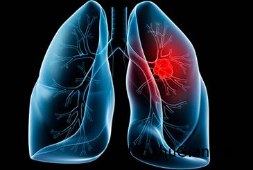 Giải mã giấc mơ thấy Phổi & ngủ nằm mơ bị đau phổi image001 jpg 15 9 201411 5717 1410862008 Giải mã giấc mơ thấy Phổi & ngủ nằm mơ bị đau phổi