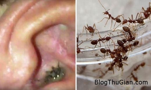 tinhhoa.net 6vHES1 20160127 soc bay kien xay to trong tai be gai Sốc nặng với hình ảnh kiến làm tổ trong tai cô bé