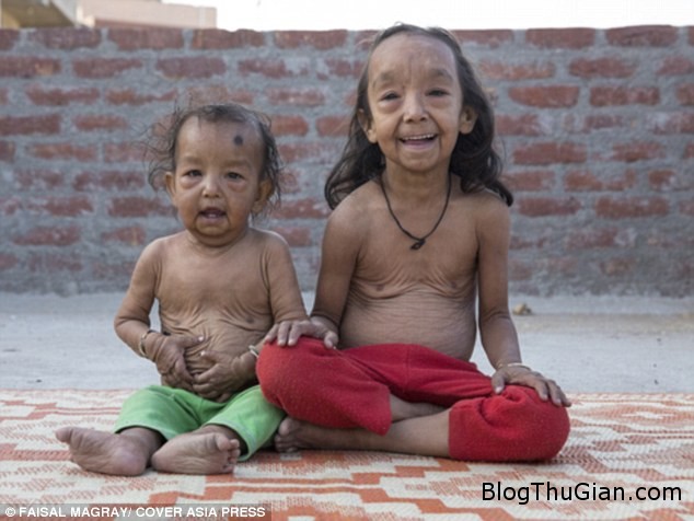 Hai cô bé người Ấn Độ mắc bệnh lạ khiến da nhăn nheo như cụ già hai chi em mac benh nguoi gia cuc hiem 3702382f27 Hai cô bé người Ấn Độ mắc bệnh lạ khiến da nhăn nheo như cụ già