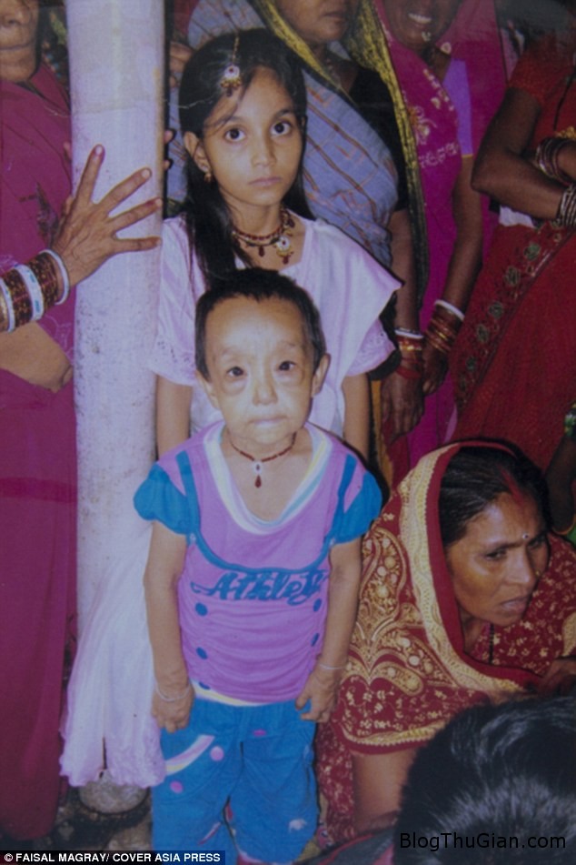 Hai cô bé người Ấn Độ mắc bệnh lạ khiến da nhăn nheo như cụ già hai chi em mac benh nguoi gia cuc hiem 3f717cce9d Hai cô bé người Ấn Độ mắc bệnh lạ khiến da nhăn nheo như cụ già