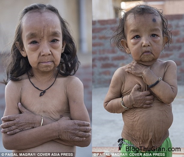 Hai cô bé người Ấn Độ mắc bệnh lạ khiến da nhăn nheo như cụ già hai chi em mac benh nguoi gia cuc hiem 646efe5d93 Hai cô bé người Ấn Độ mắc bệnh lạ khiến da nhăn nheo như cụ già